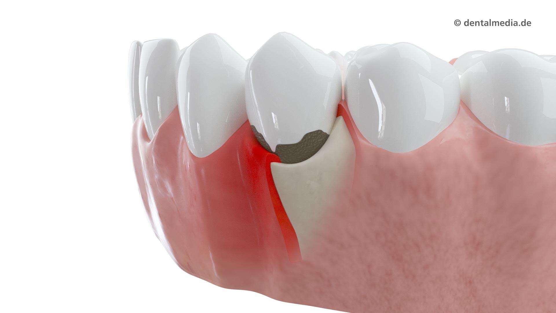 Parodontologie : Entzündetes Zahnfleisch und bakterielle Beläge auf den Zähnen